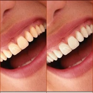 dentes-amarelados-brancos