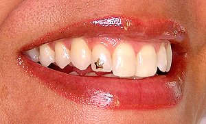 estrela piercing dente