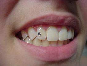 piercing no dente