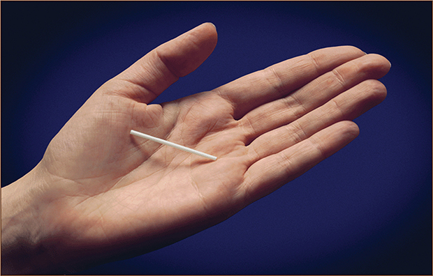Métodos contraceptivos modernos – implante